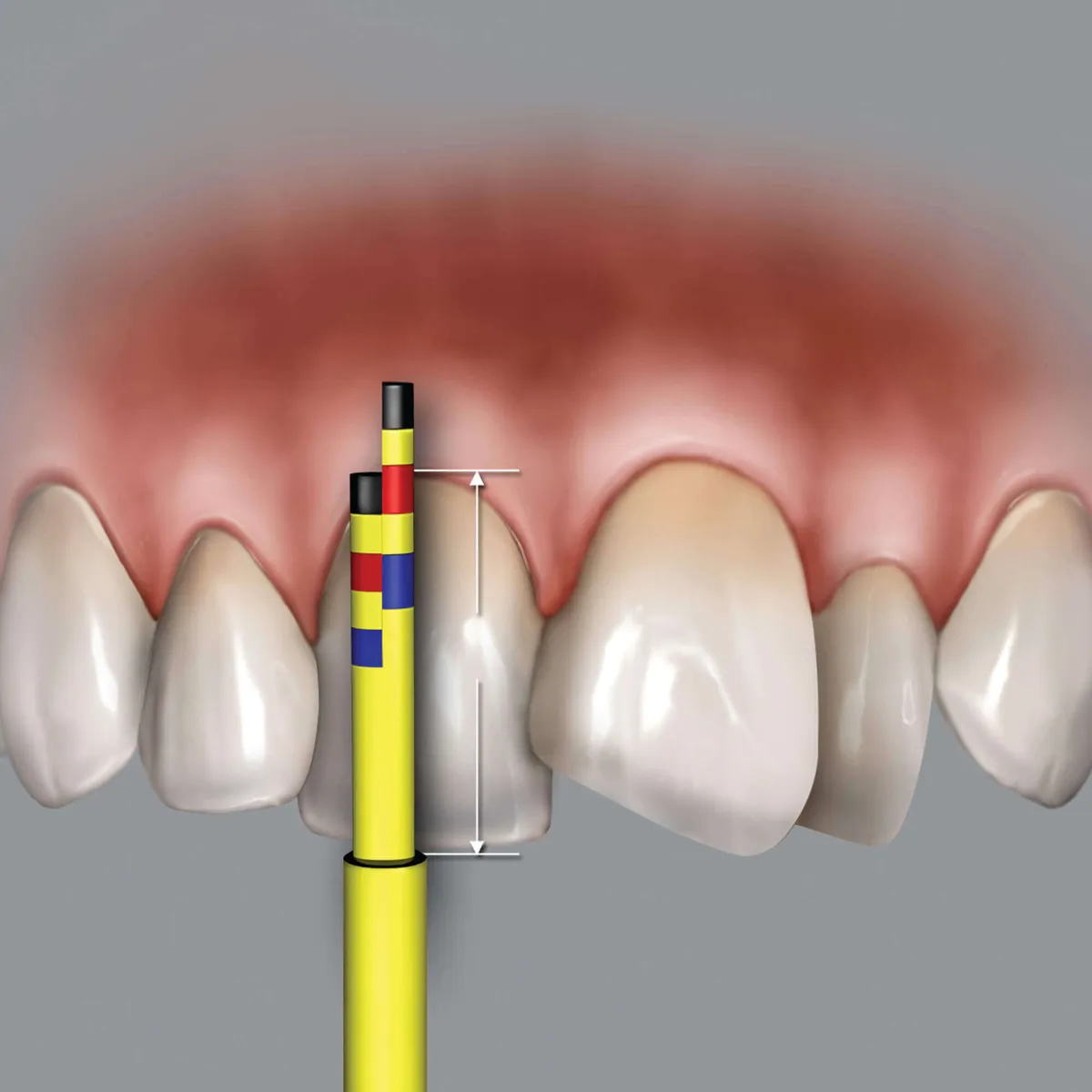 Chu Gauge Inline رؤوس بديلة (3 رؤوس)