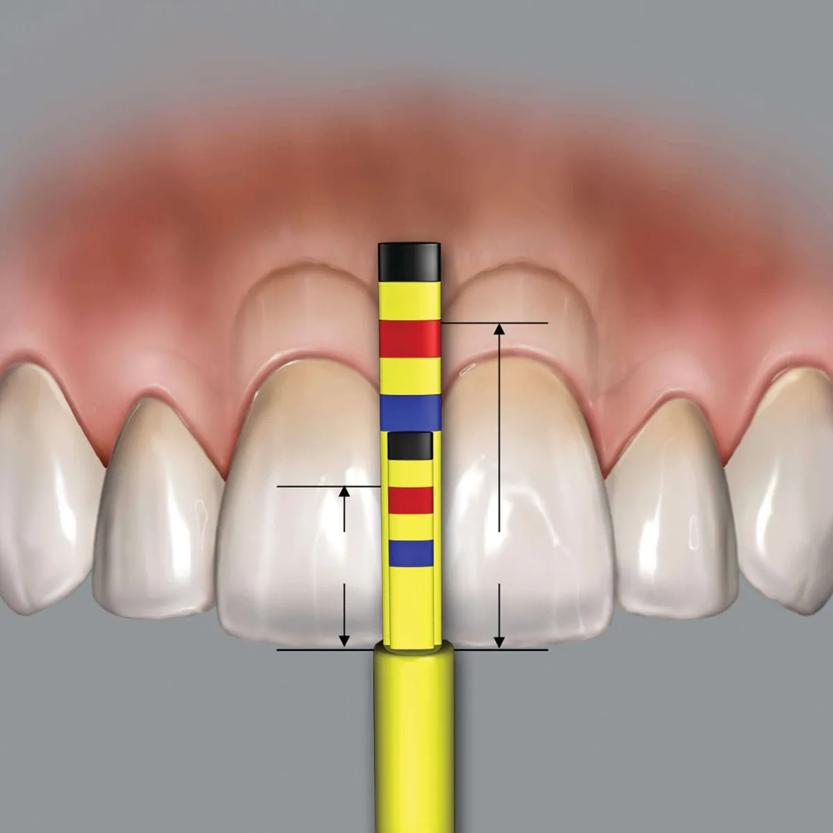 Chu Gauge Papilla رؤوس بديلة (3 رؤوس)